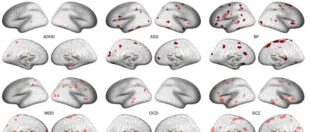 Nature Neuroscience: 精神疾病大脑结构异常在脑区、环路与网络水平存在异质性