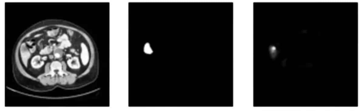 U-Net医学影像分割肝脏CT的肿瘤识别过程及原理解析