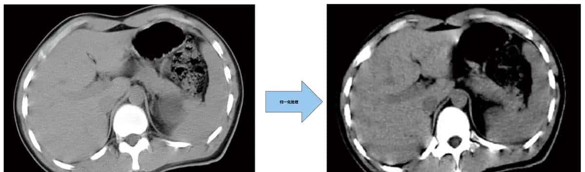 U-Net医学影像分割肝脏CT的肿瘤识别过程及原理解析
