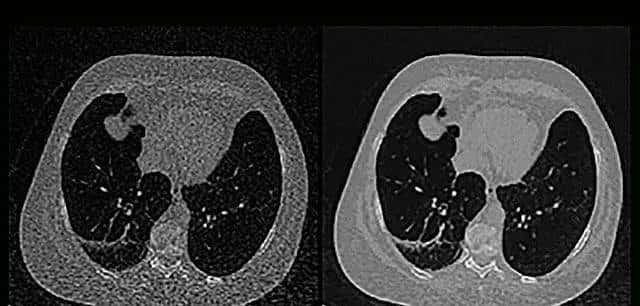 U-Net医学影像分割肝脏CT的肿瘤识别过程及原理解析