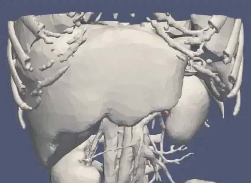 U-Net医学影像分割肝脏CT的肿瘤识别过程及原理解析