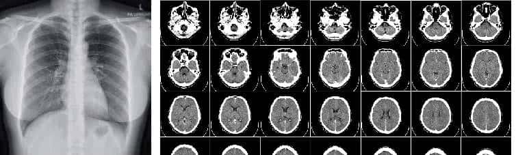 U-Net医学影像分割肝脏CT的肿瘤识别过程及原理解析