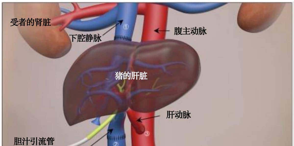 全球首例！除了心、肝、肾，猪的这个器官也成功移植给人