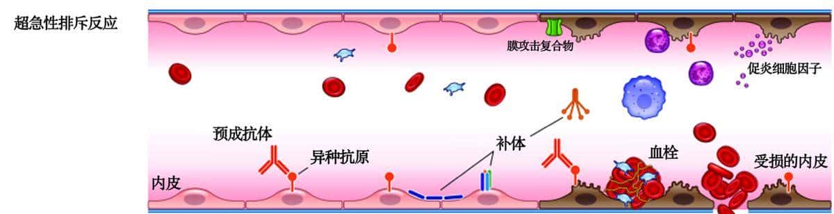 全球首例！除了心、肝、肾，猪的这个器官也成功移植给人