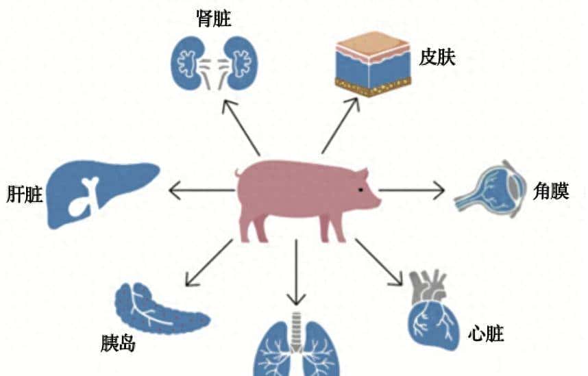 全球首例！除了心、肝、肾，猪的这个器官也成功移植给人